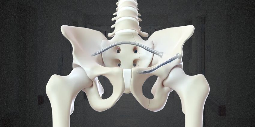 FDA Clears CurvaFix Low Profile: A New Twist in Pelvic Fixation
