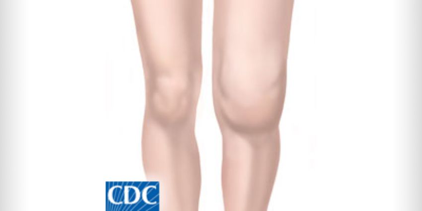 CT Phenotyping Reveals Four Knee Types for TKA