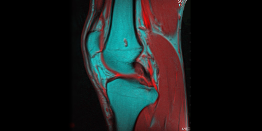 Beyond CPAK: Why True Knee Phenotyping Needs to Go 3-D