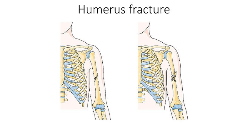 Humeral Shaft Fractures: Fixation Versus Bracing at 3 Months