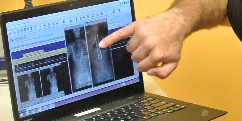 When Straight Spines Don’t Mean Stronger Lungs: The Scoliosis Puzzle