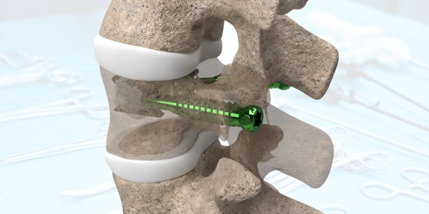 Amber Implants’ VCFix® Steps Into the Spotlight