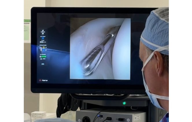 Arthrex Achieves First Case with NanoNeedle™ Scope 2.0