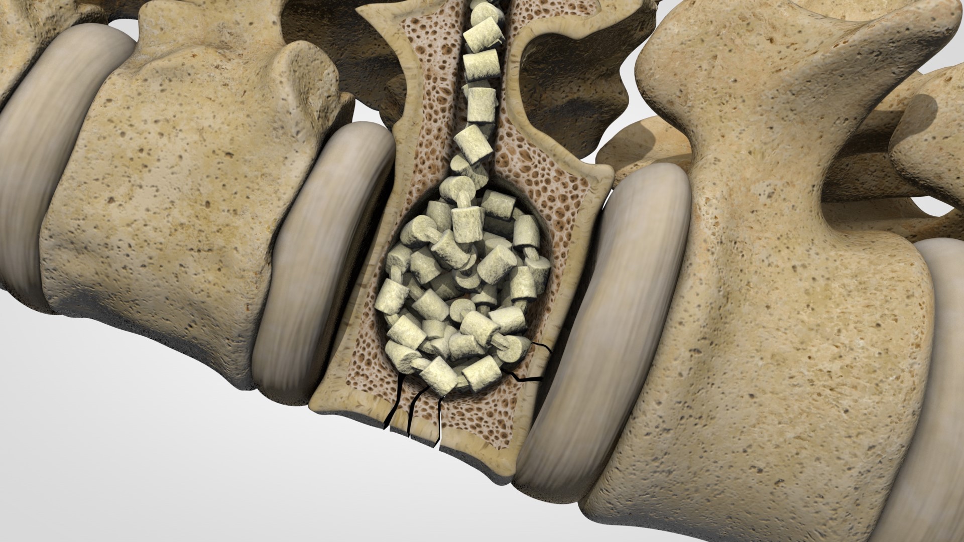 Lenoss Medical Expands Global Patent Protection for OsteoPearl®, Transforming the Future of Vertebral Compression Fracture Care