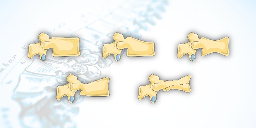 Cracking the Code of Rod Fracture in ASD Surgery