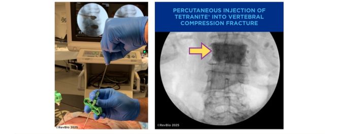 RevBio Receives a $2.2 Million Phase II NIH Grant to Further Develop the Minimally Invasive Use of TETRANITE® to Treat Complex Spine Fractures