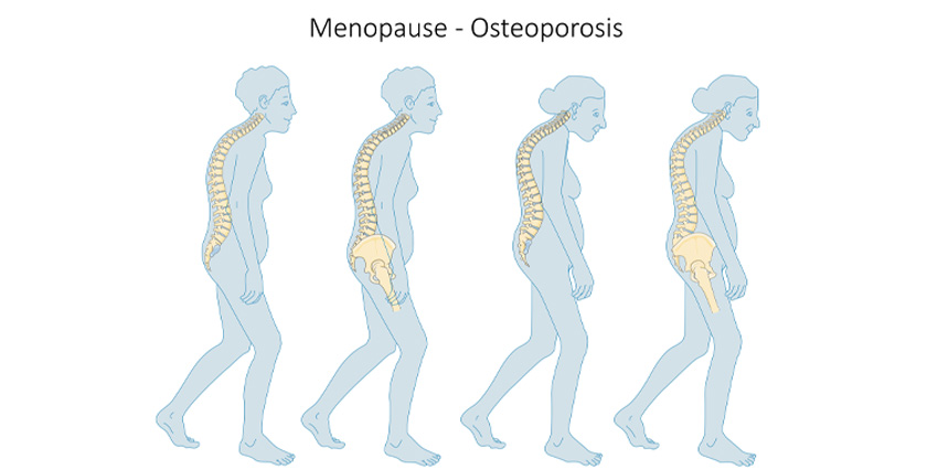 Predicting Failure in Osteoporotic Vertebral Compression Fractures
