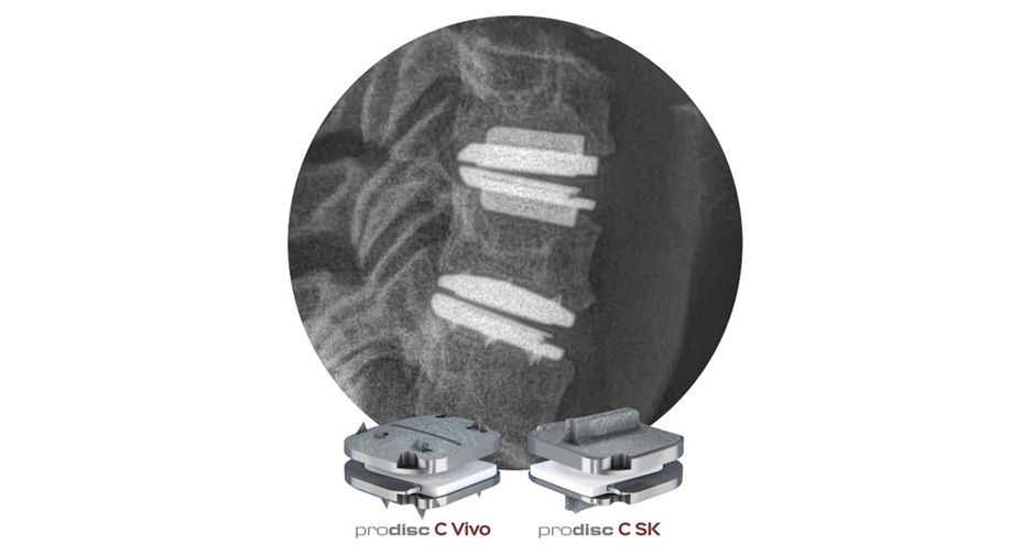 Centinel Spine® Receives Two-Level FDA Approval for prodisc® C Vivo and prodisc® C SK Match-the-Disc™ Cervical Total Disc Replacement Devices