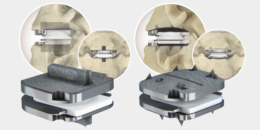 FDA Approves 2-Level Indications for TWO prodisc® C Devices