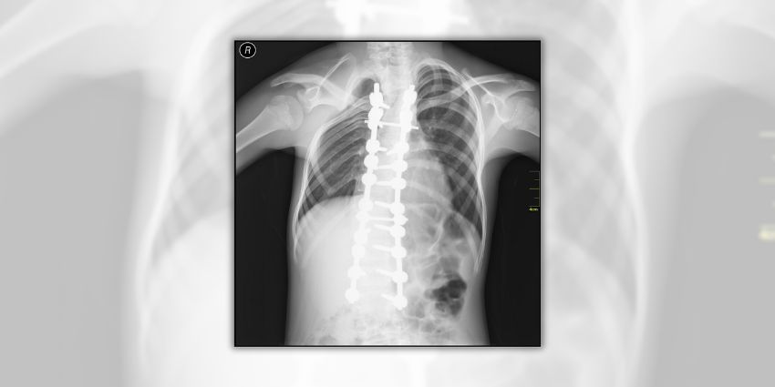 The 6.5 mm Rule Every Spine Surgeon Should Know
