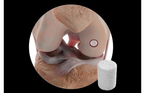 Smith+Nephew announces new category I CPT® code for its CARTIHEAL™ AGILI-C™ Cartilage Repair Implant