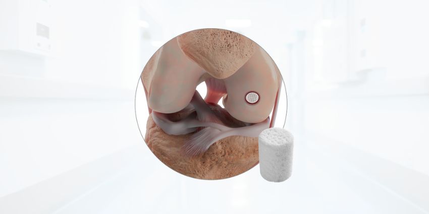 A Win for Cartilage Repair: CPT Code for CARTIHEAL™ AGILI-C™
