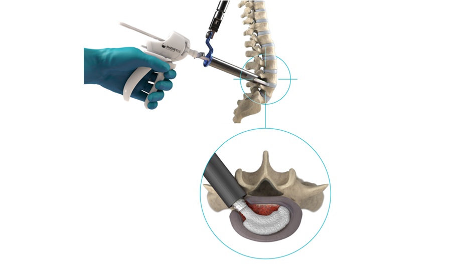 Kuros Biosciences debuts commercial launch of MagnetOs MIS Delivery System at SMISS 2025
