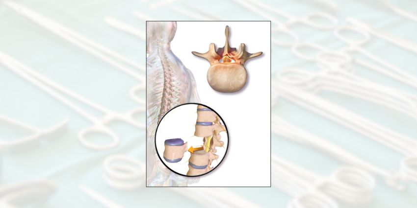 The MITPA Corpectomy: When One Pedicle Is All You Need
