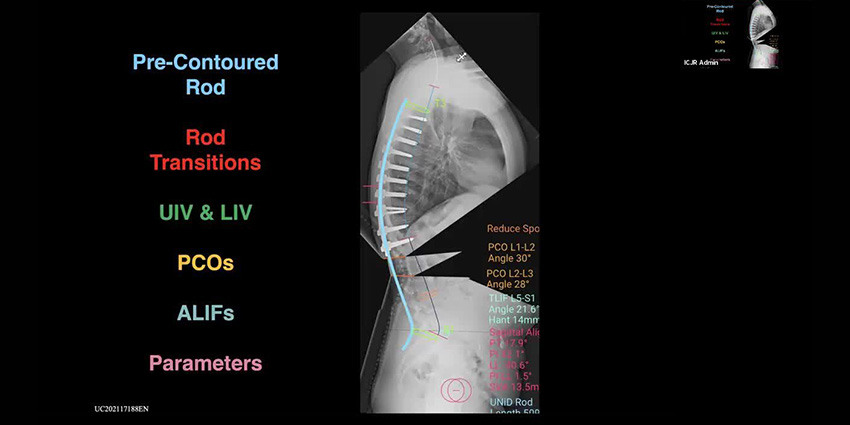 Coronal Plane Correction Gets a Glow-Up With Patient-Specific Rods