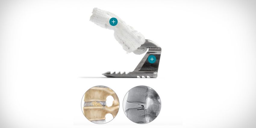 Endoscopy Meets Annular Closure