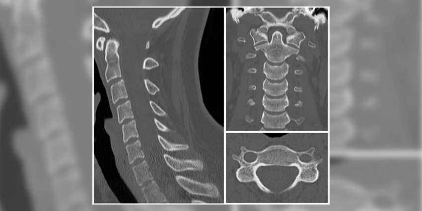 Fine vs. Sclerotic Trabecula: Understanding Your Post-PLIF CT
