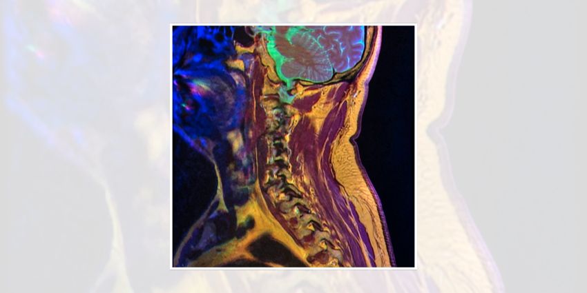 Battle of the VBQs: Can MRI Predict Fusion Success?