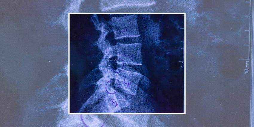 When microRNAs Attack: miR-93-5p Takes the Fall