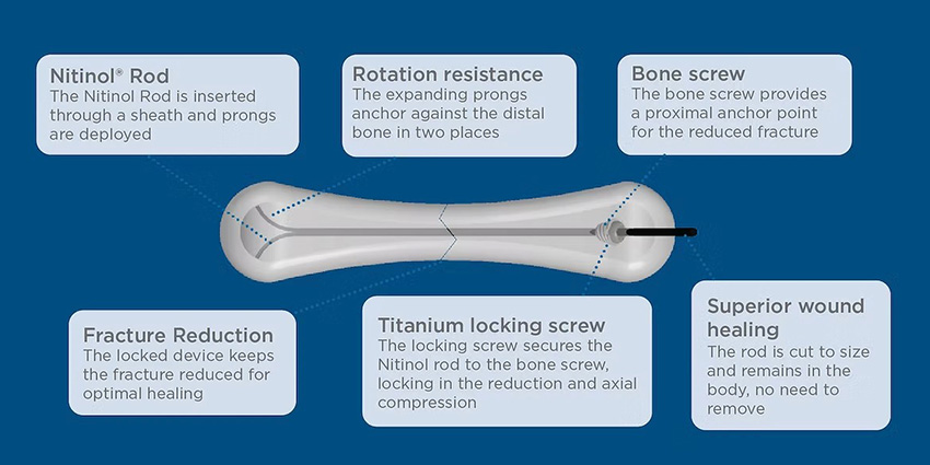 Meduloc Steps Into the Spotlight With FDA Clearance