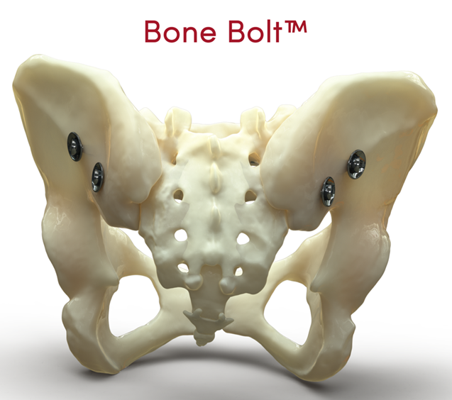 University Of Utah Orthopaedic Innovation Center Announces Completion of First Bone Bolt™ Cases