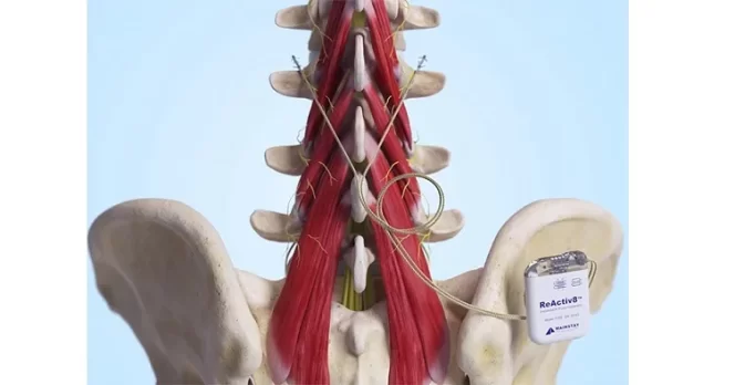 Mainstay Medical Announces Coverage Recommendation from the International Society for the Advancement of Spine Surgery (ISASS) for ReActiv8