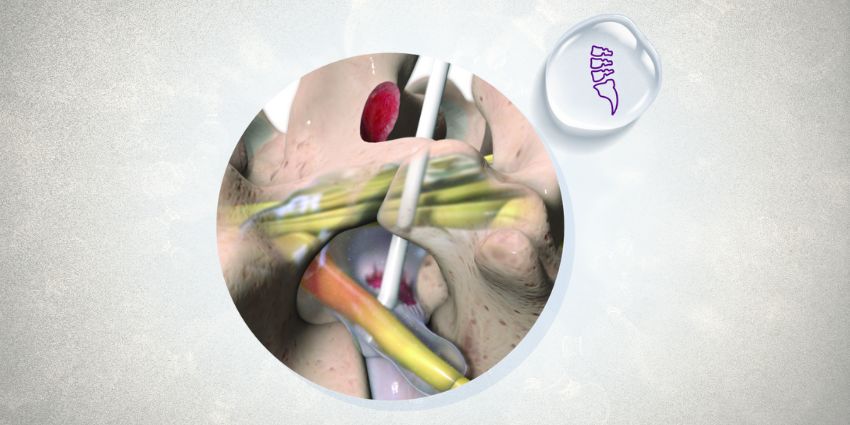 Can a Little Gel After Discectomy Make Good Surgery Even Better?