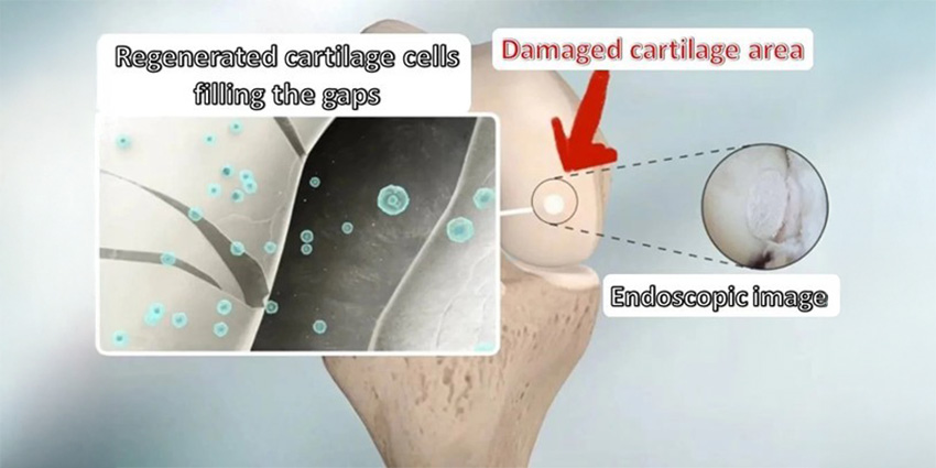 Cartilage Repair: 5-Year Outcomes From Cartilage Repair Thunderdome