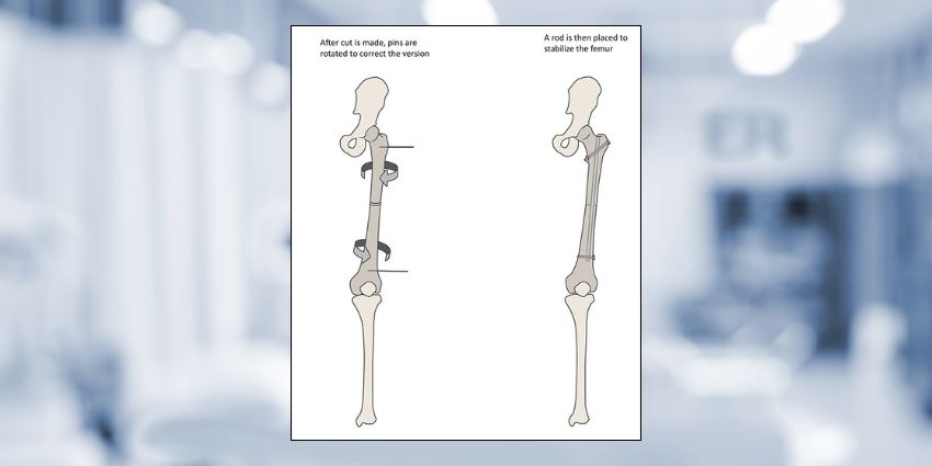 When Is Femoral Derotational Osteotomy the Superior Choice?