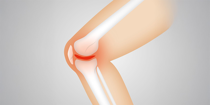 How Femoral Tracker Placement Can Quietly Tension Your Robotic TKA