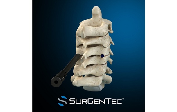 SurGenTec® Secures FDA Clearance for ION-C™ Facet Fixation System — Designed to Support Fusion While Preserving Alignment