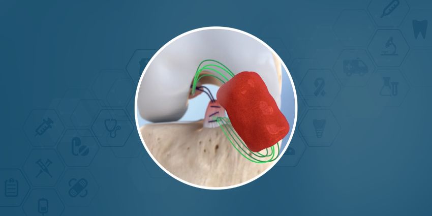 Updated Labeling for ACL Implant