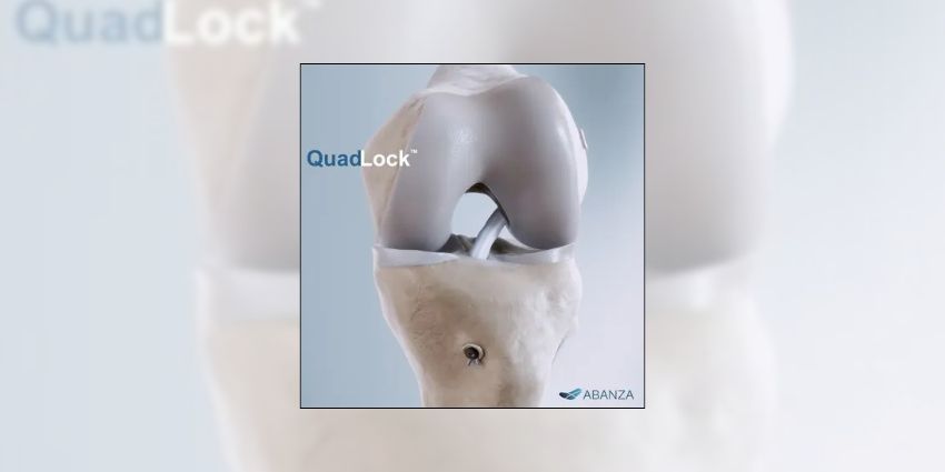 QuadLock™ Enters the Chat: ACL Fixation That Doesn’t Budge