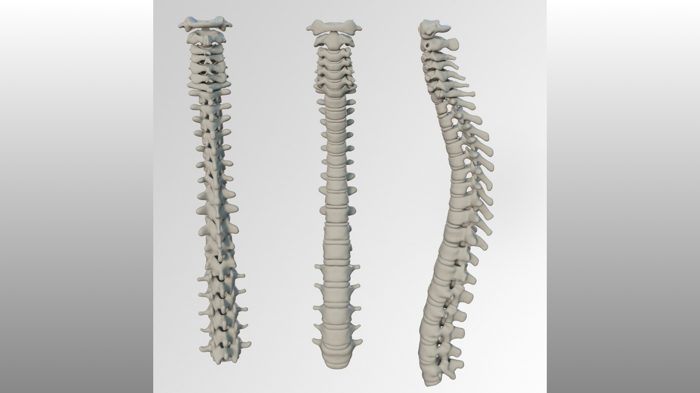 Does Bone Quality Really Doom Your ACDF?
