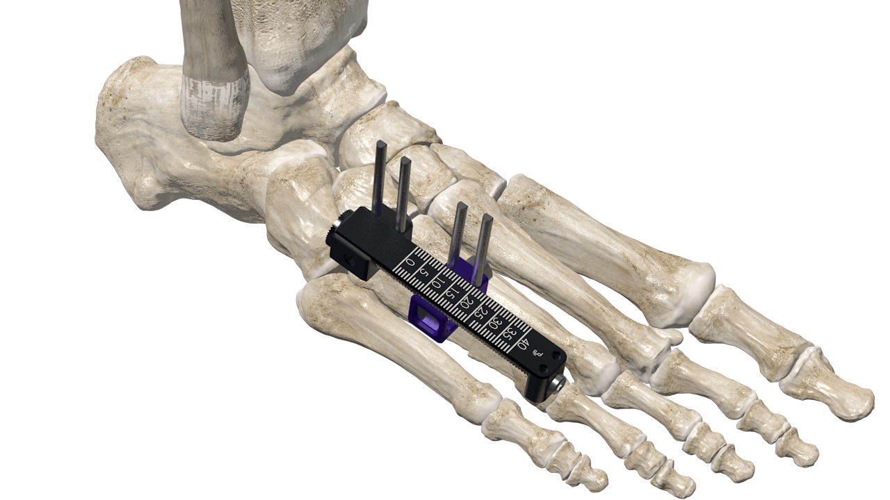 Millimeters Matter: the Brachiator™ Mini-Rail External Fixation System
