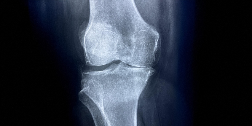 Do Short Tibial Stems Really Save the Day?