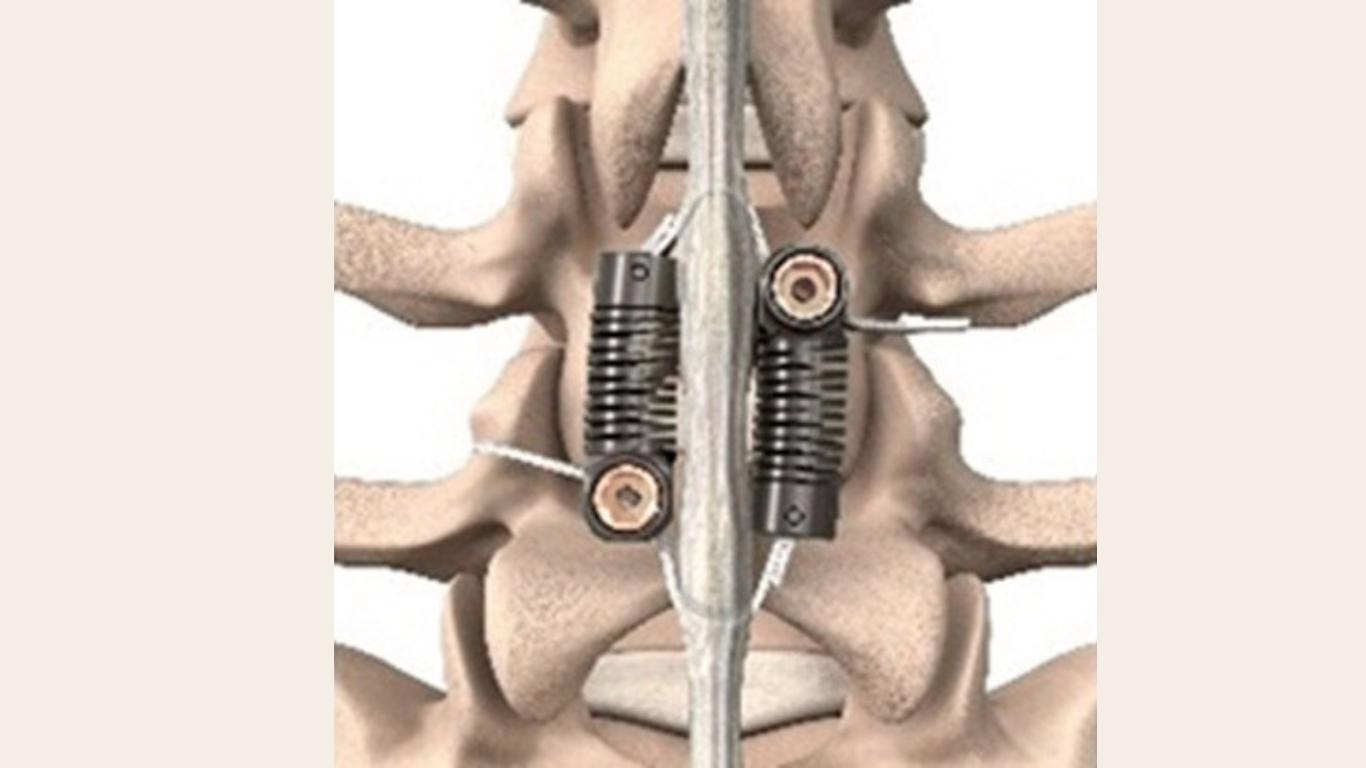 FDA Grants PMA Approval to LimiFlex™ Dynamic Sagittal Tether