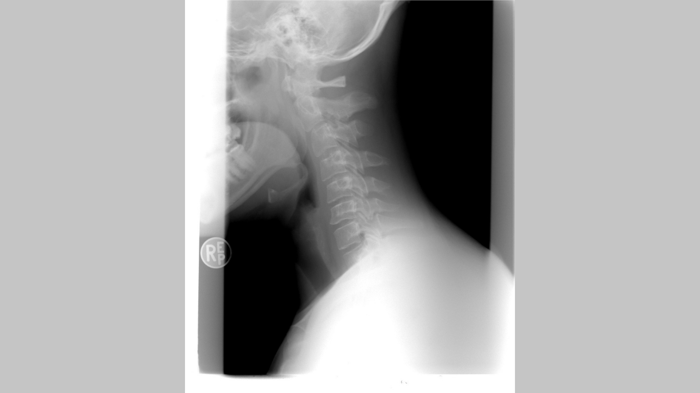 When 4cm Is the Enemy: A Cervical Deformity Reality Check