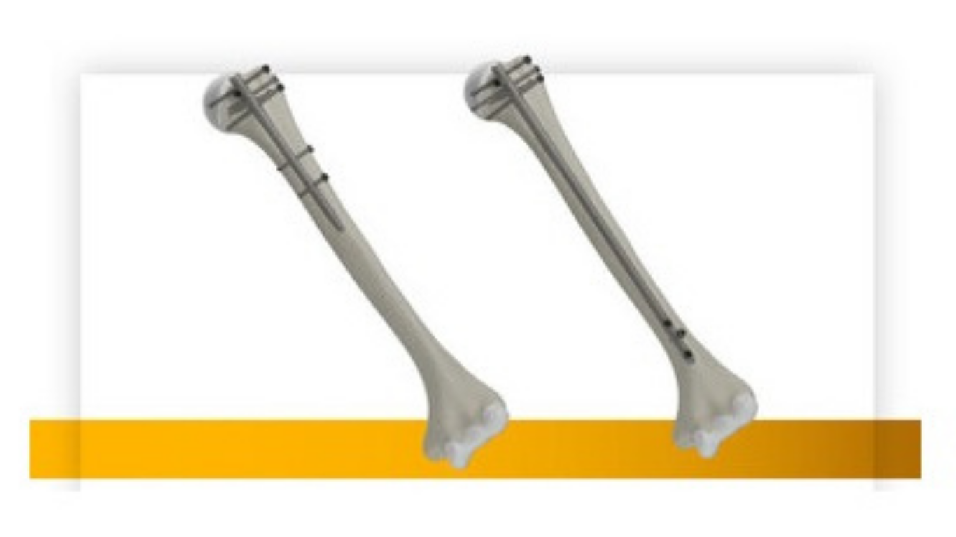 Stryker launches T2 Alpha Humerus Nailing System, supporting surgical workflow and care for complex fractures