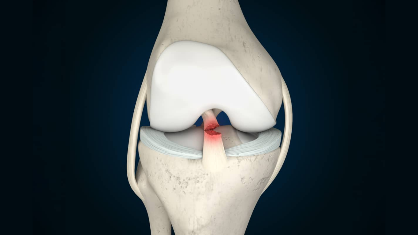 Revision ACL vs. The “Other Knee”: A Tale of Two Second Surgeries