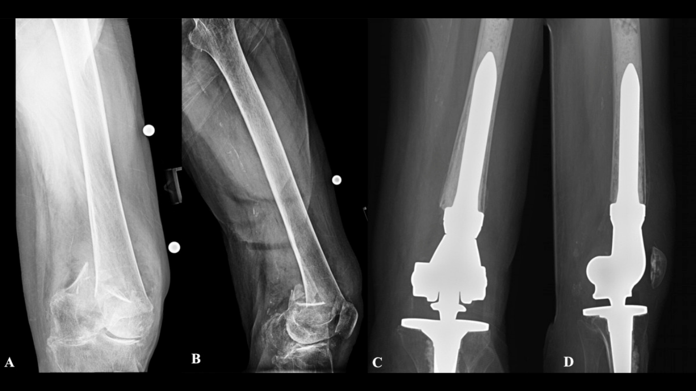 The Cement Mantle vs a Distal Femoral Replacement