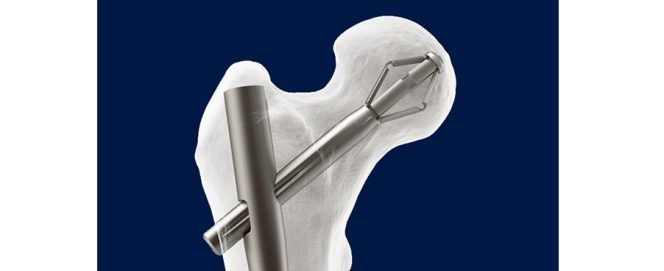 X-Bolt Orthopedics Receives Innovative Technology Contract from Vizient for their Pro-X1 Trochanteric Nail