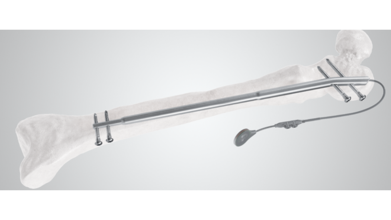 Fitbone™ Product Expansion in Limb Reconstruction