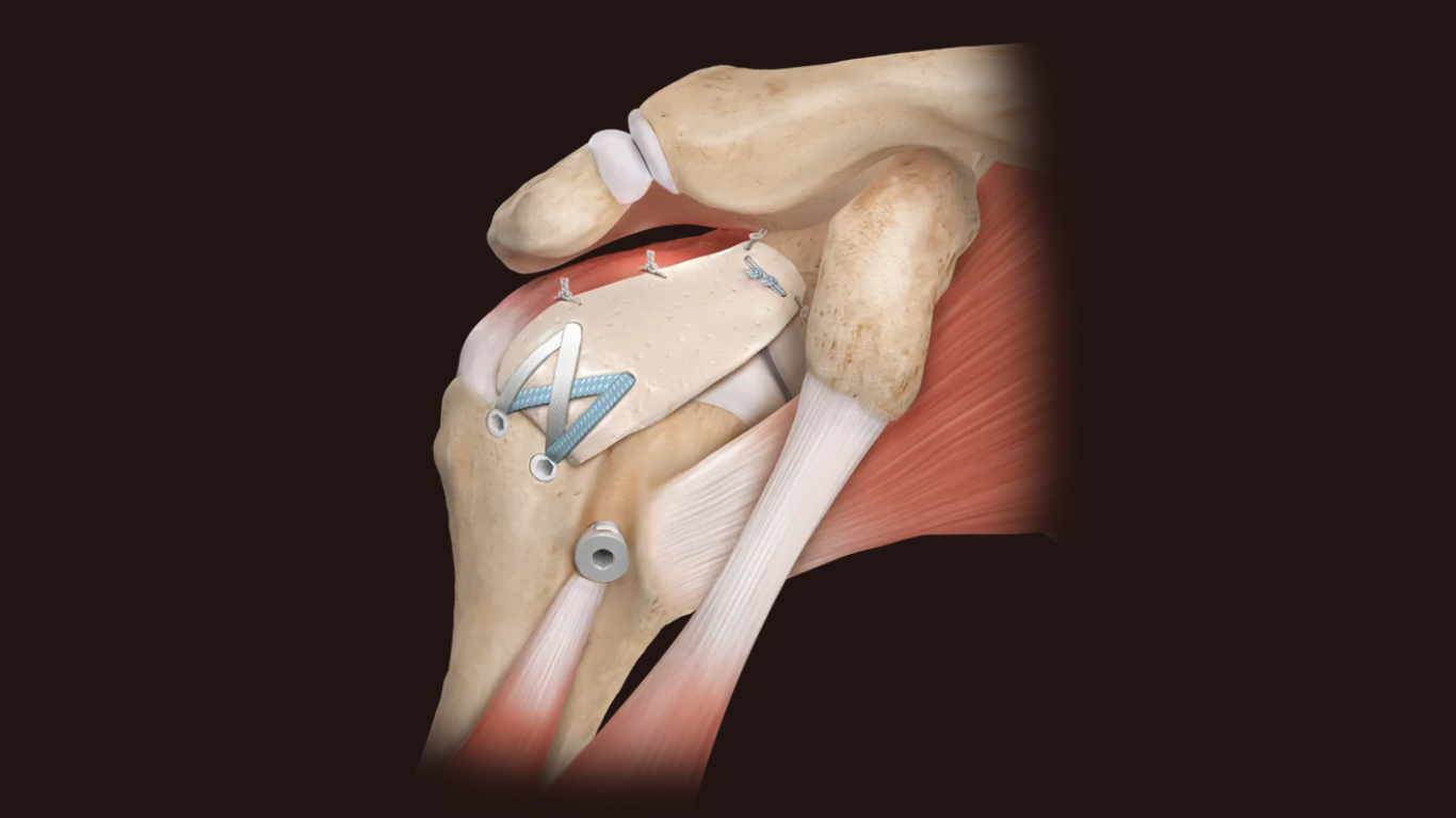 When the Cuff Is Gone but the Patient Isn’t Ready for a Prosthesis