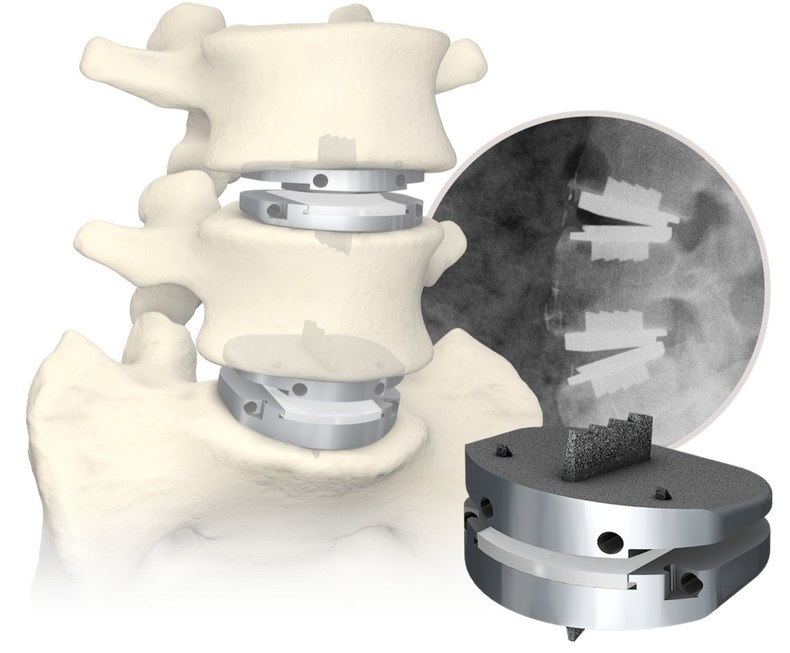 Lumbar Disc Replacement: Still Spinning After Two Decades