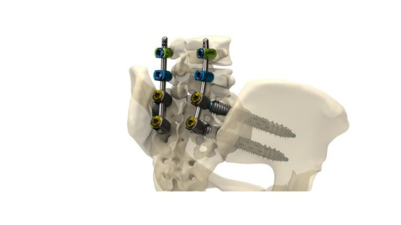Genesys Spine Announces Launch of the SIros-X™ System for Sacroiliac Joint Fusion and Pelvic Fixation of Pedicle Screw Constructs