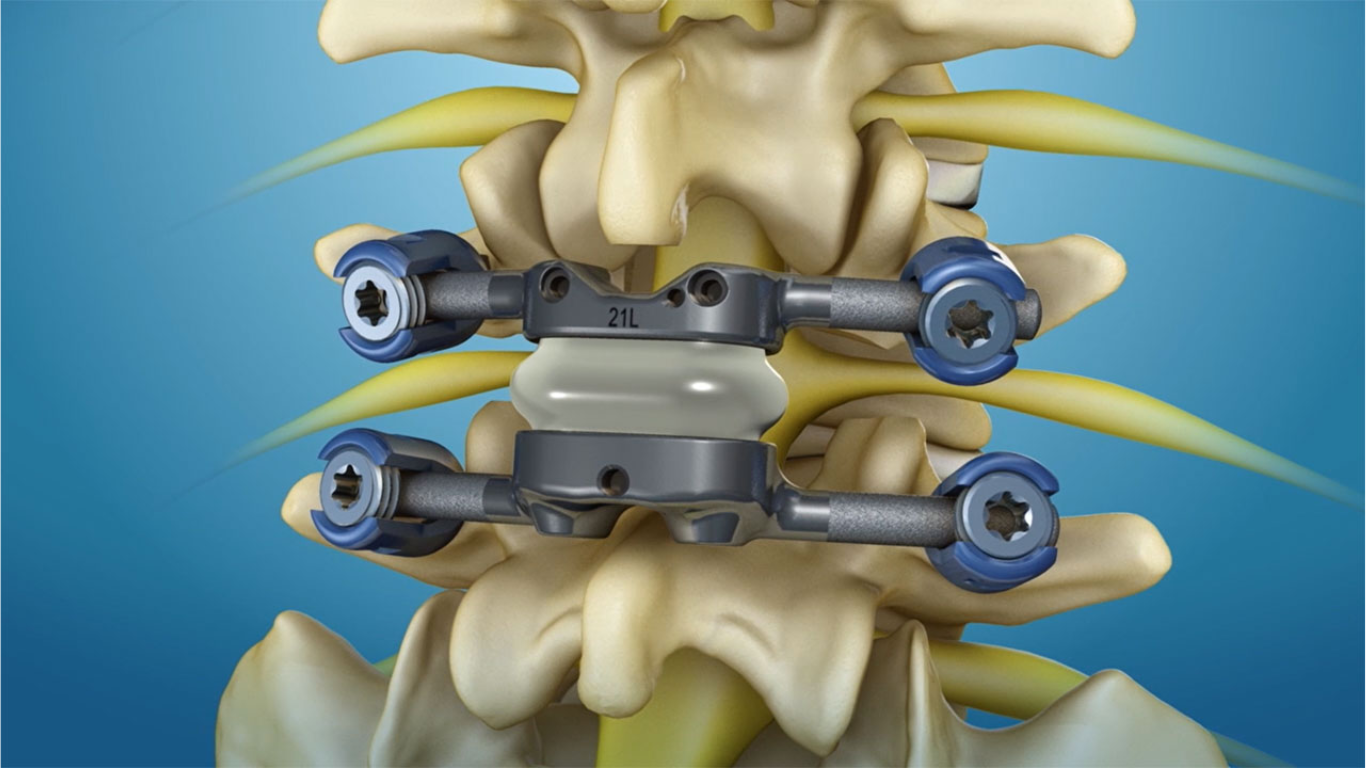 Facet Arthroplasty vs TLIF in Lumbar Spondylolisthesis 2Y Results!