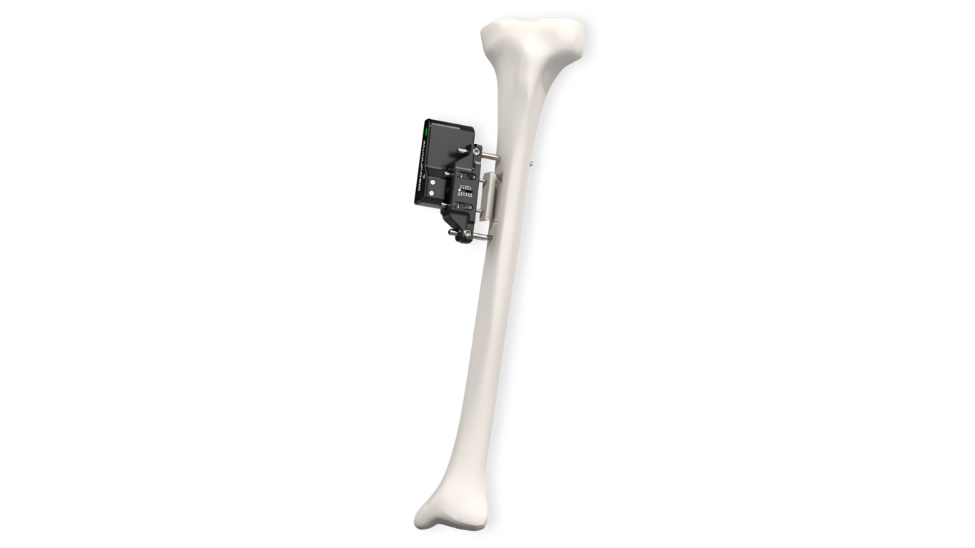 Biodynamik Receives FDA IDE Approval for Pivotal U.S. Trial of XT3 System in Diabetic Foot Ulcers