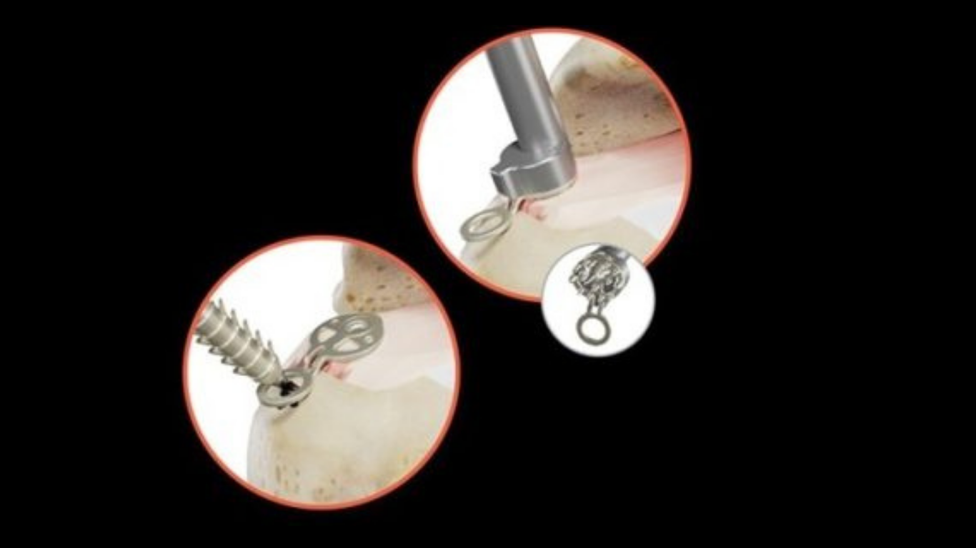 FDA Approves Expanded Clinical Applications for SINEFIX™ in Soft Tissue Repair
