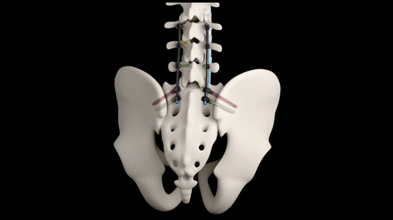 Life Spine Announces Expanded Indications for ARx® SAI Spinal Fixation System